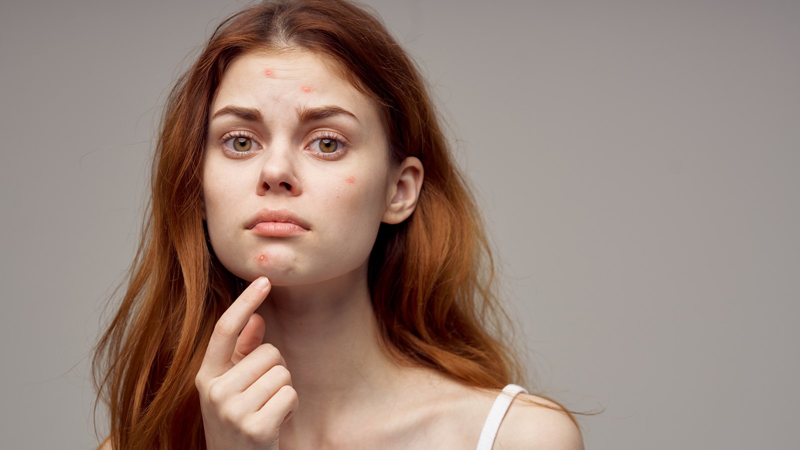 best-acne-spot-treatments