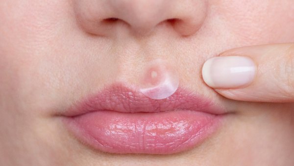 Pimple-Patch-Stock-Photo