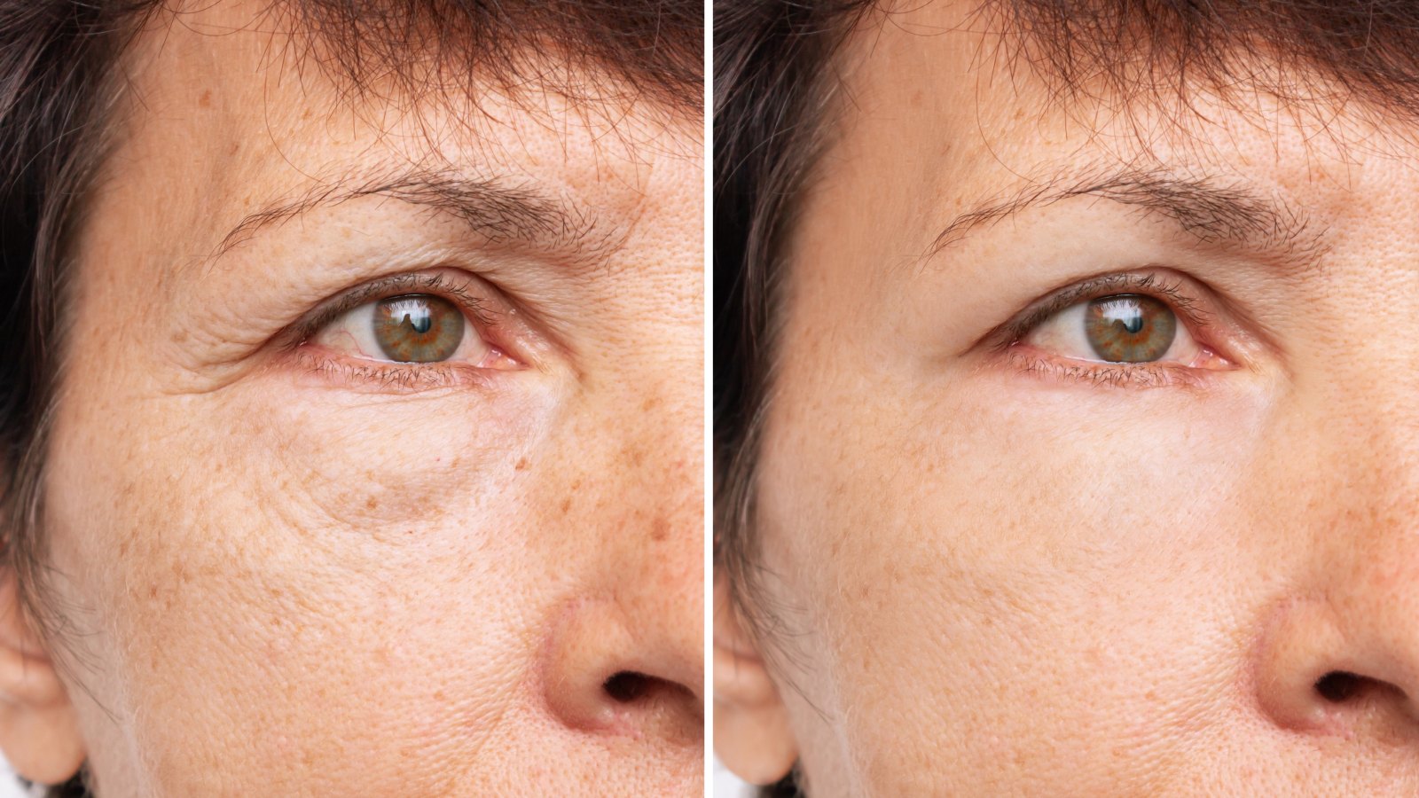 Under-Eye-Wrinkles-Before-After-Stock-Photo