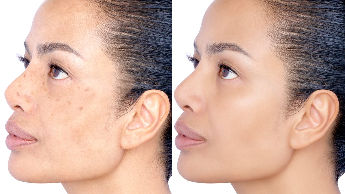 amazon-dark-spot-cream