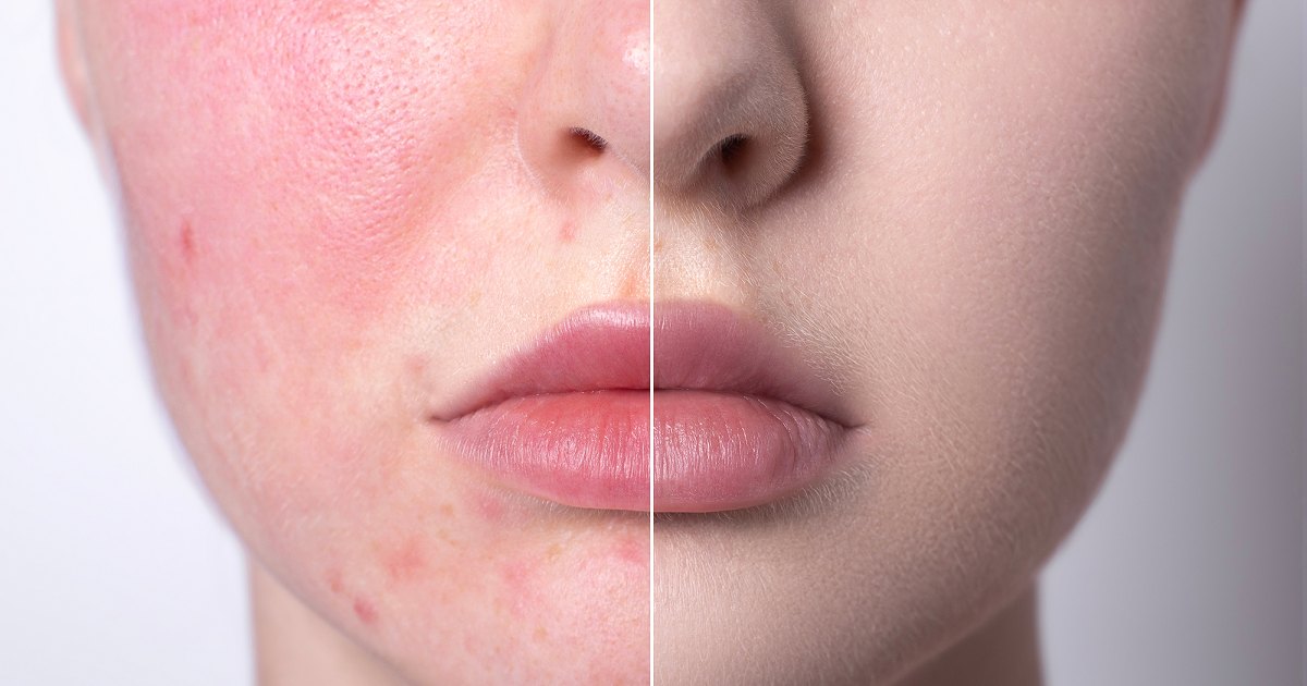 Angry Skin? This Redness Relief Moisturizer Is on Sale for Just $15 Angry Skin? This Redness Relief Moisturizer Is on Sale for Just $15