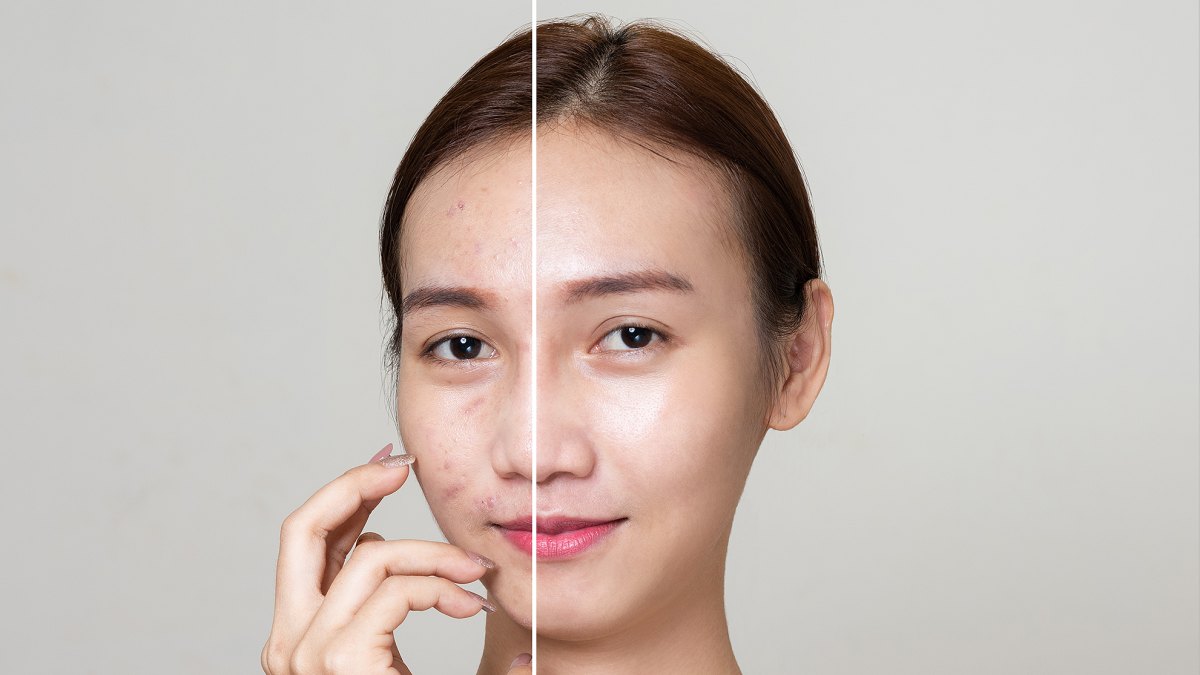 amazon-bee-rx-blemish-repair