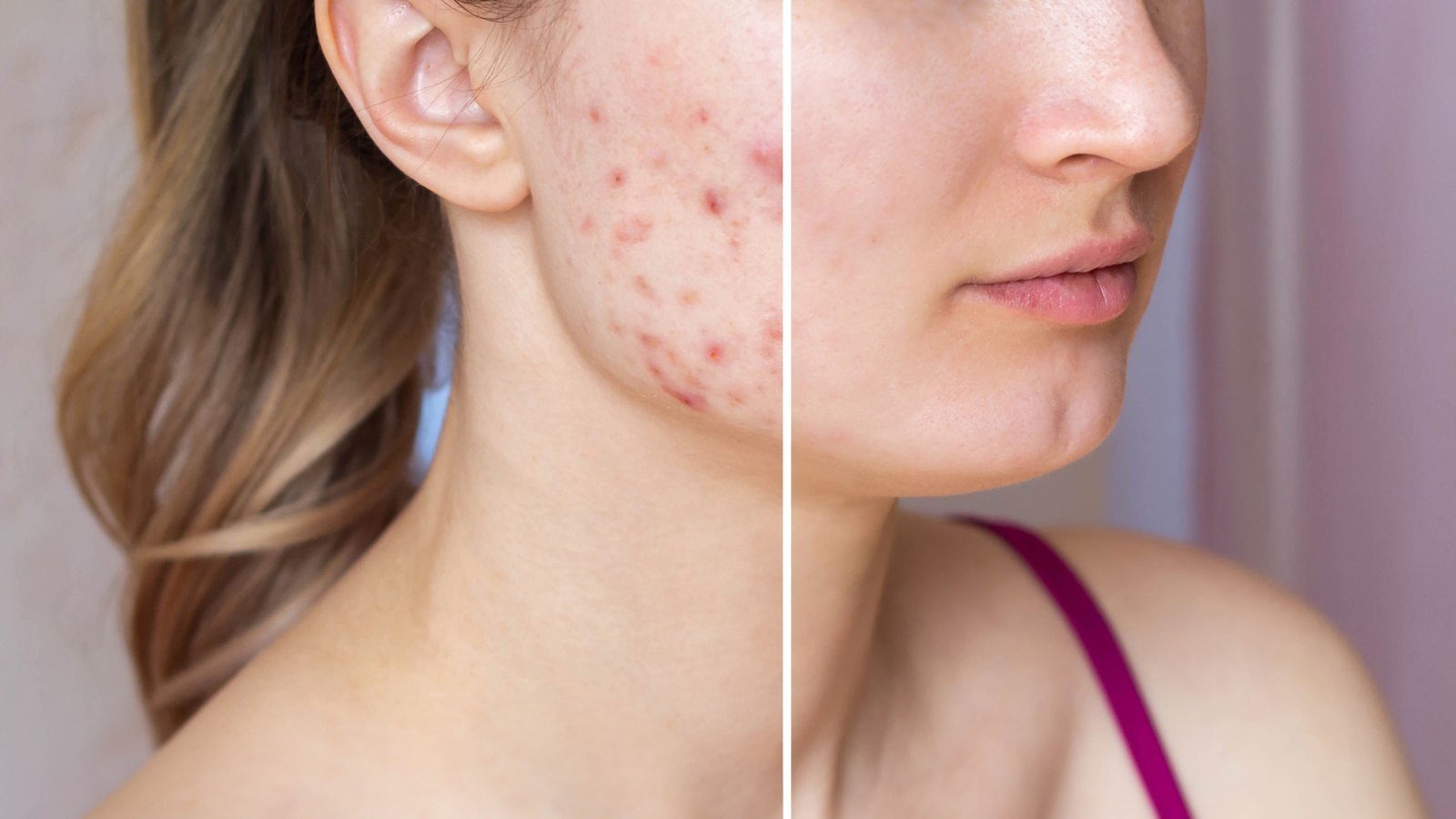 before-after-adult-acne