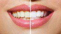 ollm-teeth-whitening-kit