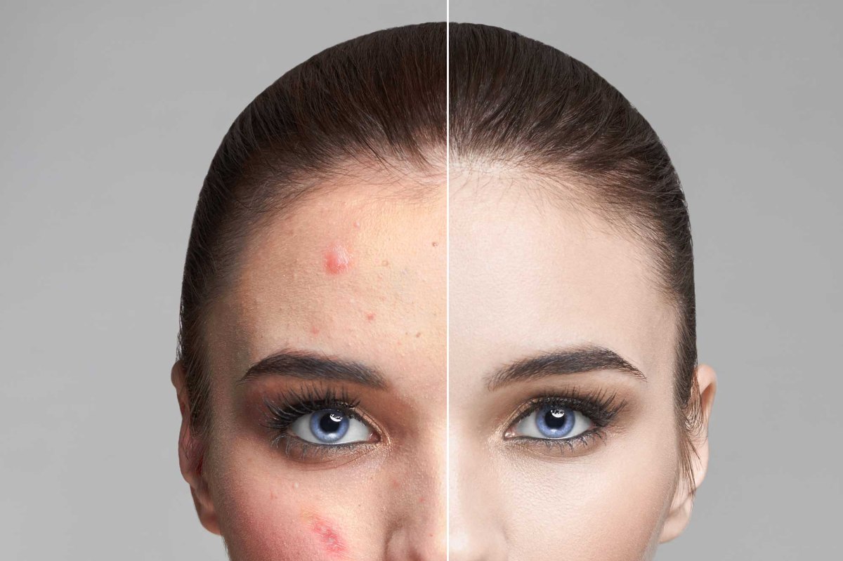 Acne
