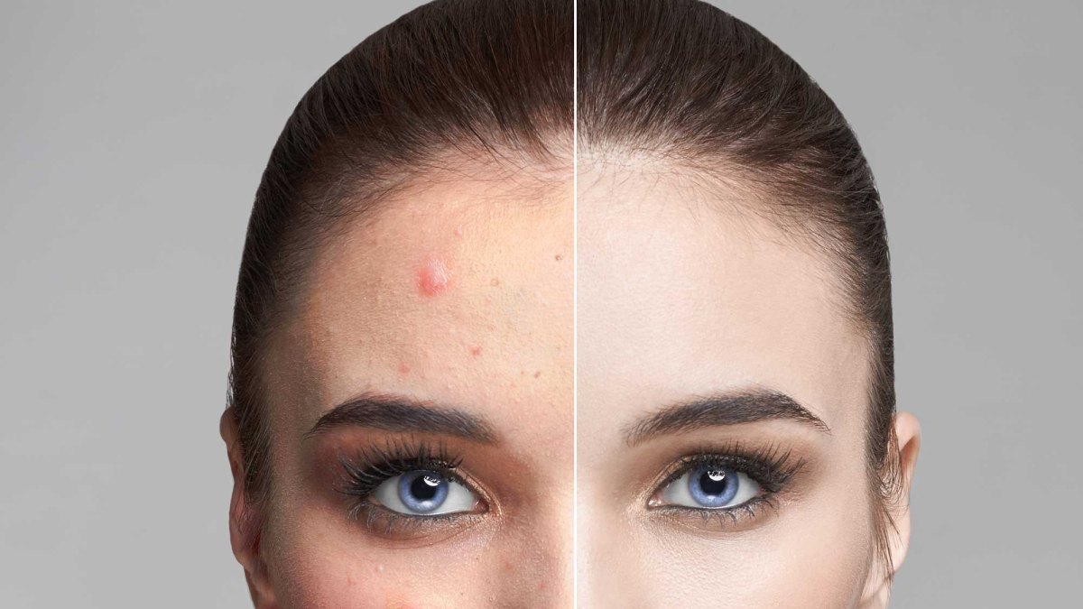 Acne