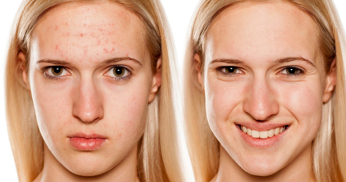 BeforeAfterAcne