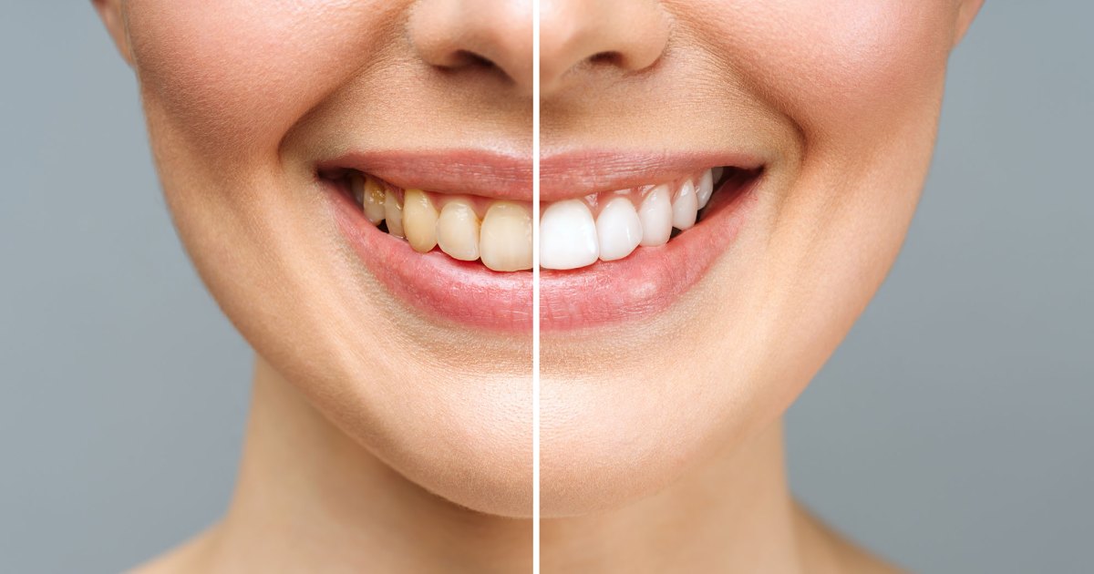 These Crest 3D Whitestrips Promise a Brighter Smile in 20 Days