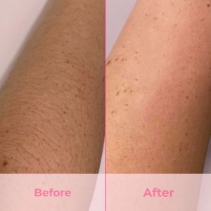 hair removal devices
