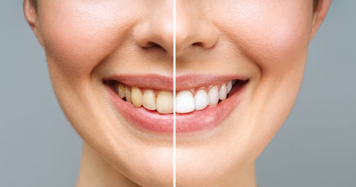 The Best Early Amazon Prime Day 2023 Teeth Whitening Deals The Best Early Amazon Prime Day 2023 Teeth Whitening Deals