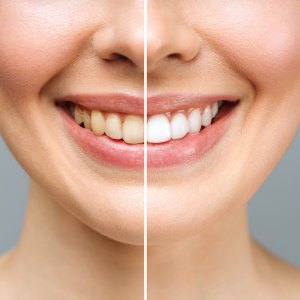 teeth whitening deals