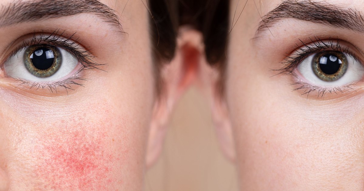 10 Best Moisturizers for Rosacea 10 Best Moisturizers for Rosacea