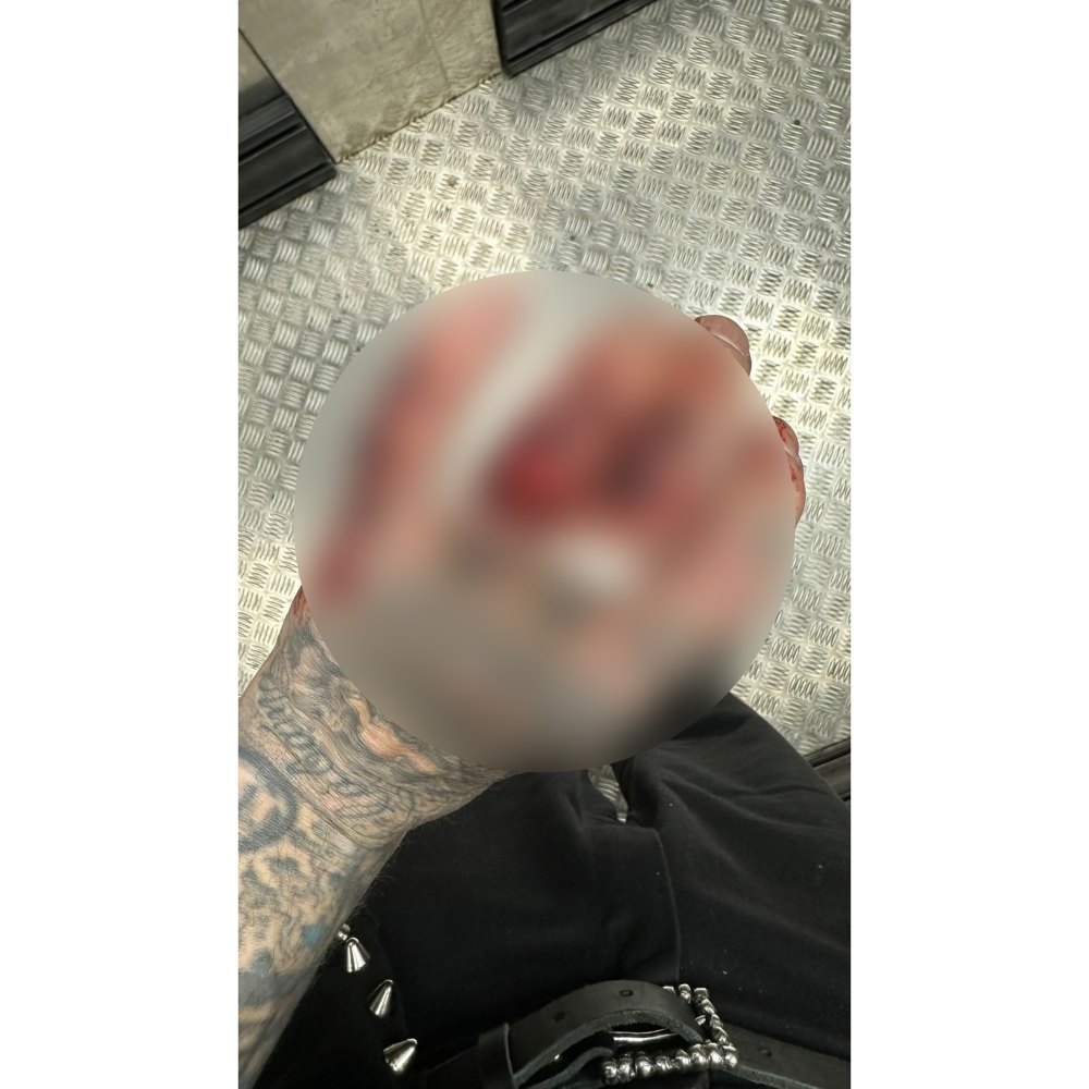 Travis Barker Unveils Bloody Hand Injury