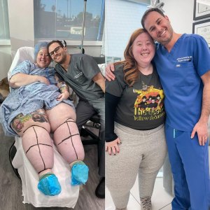 Lipedema