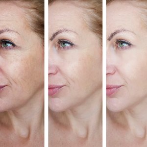 female eye wrinkles before and after treatments