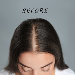 Woman with hair loss problem before and after treatment on grey background, collage. Visiting trichologist