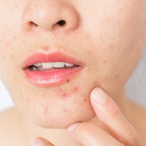 Conceptual of problems on woman skin.