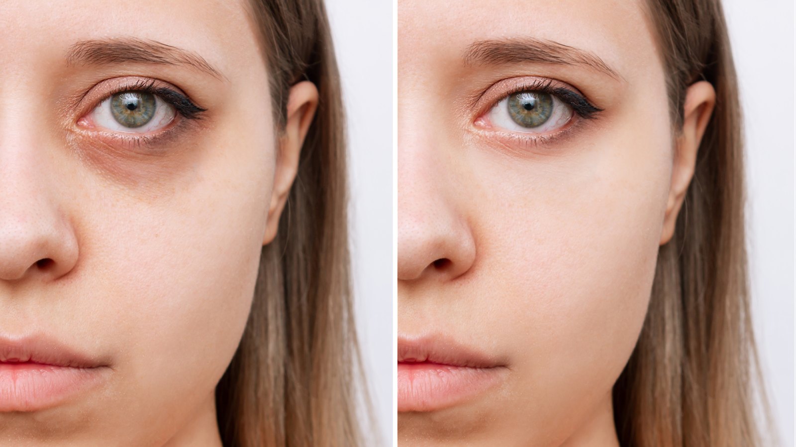 Cropped shot of young woman's face with dark circles under eyes before and after cosmetic treatment.