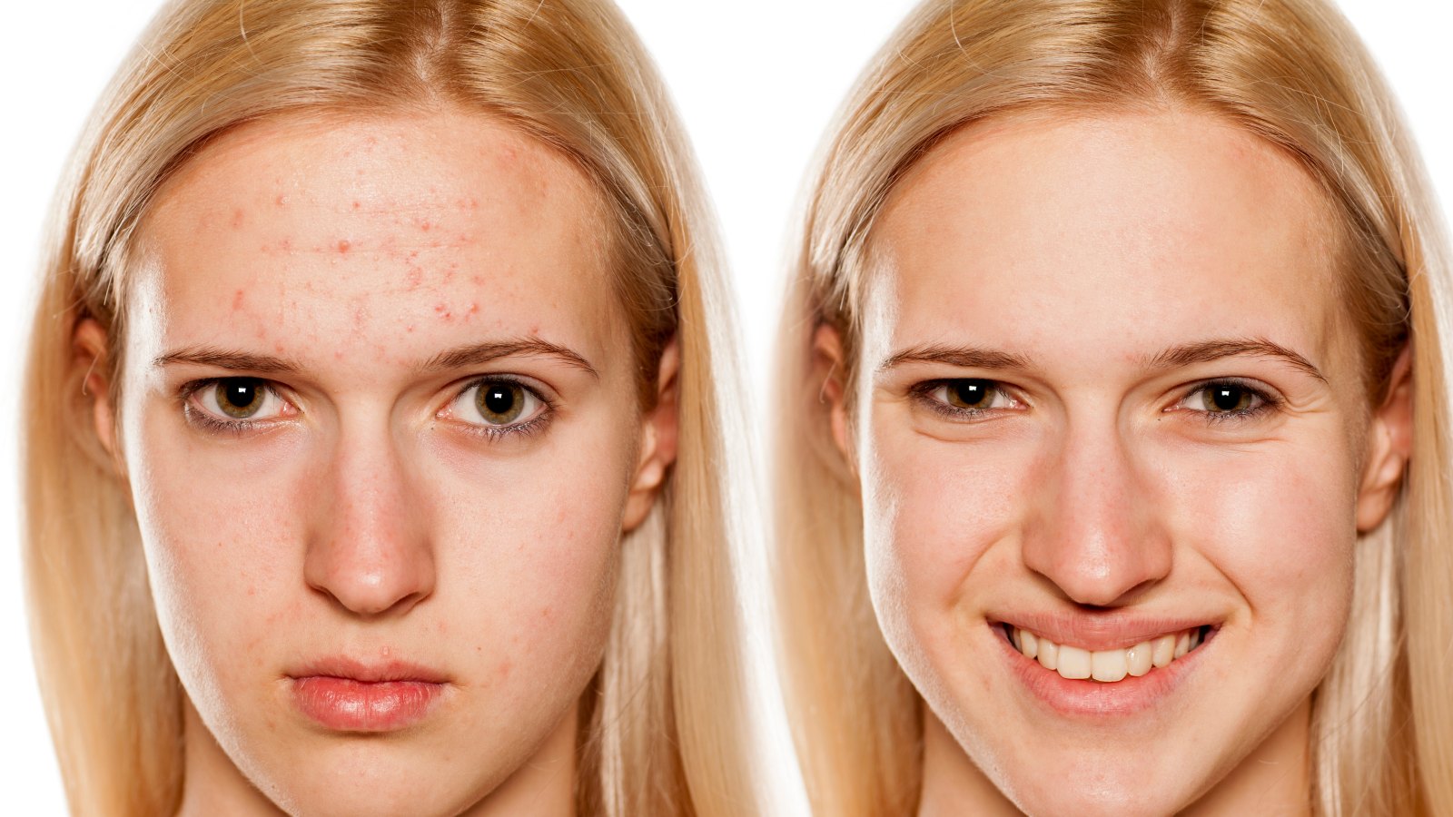 hormonal acne before and after
