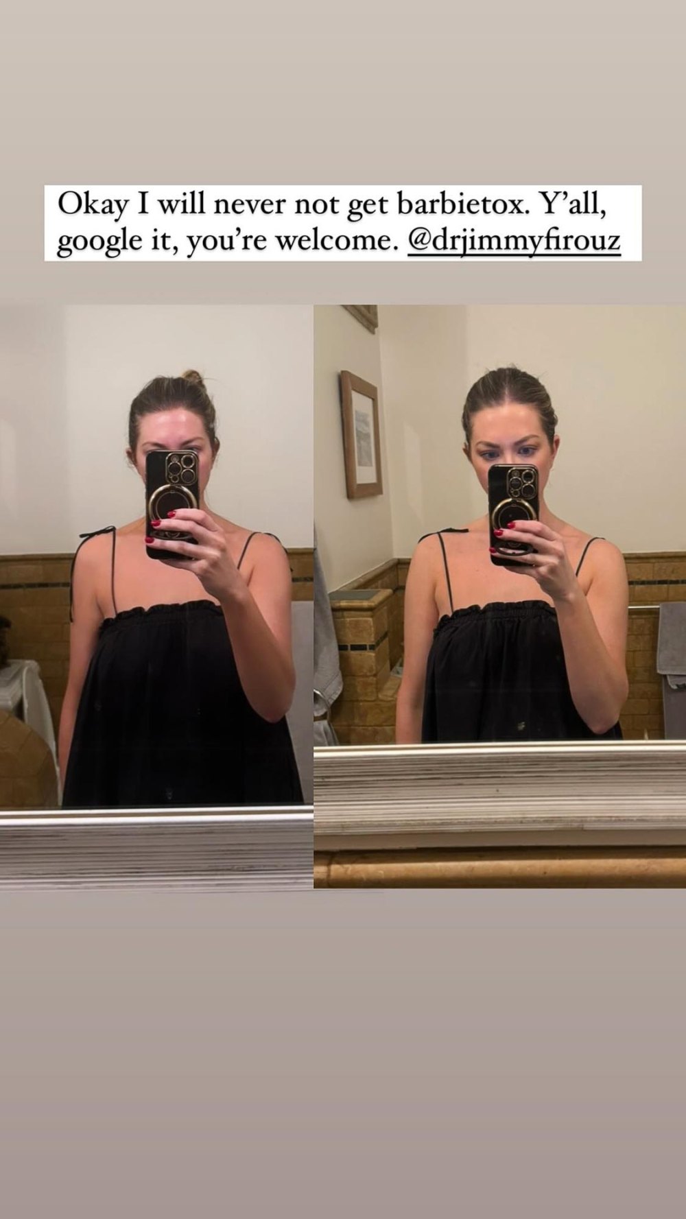 Stassi Schroeder Clark shows the effects of Barbietox after getting Botox in her shoulders 888