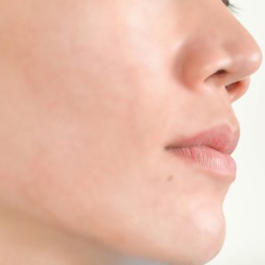 Acne scars and pores. Black spots, wrinkles and skin problems Facial Treatment Step