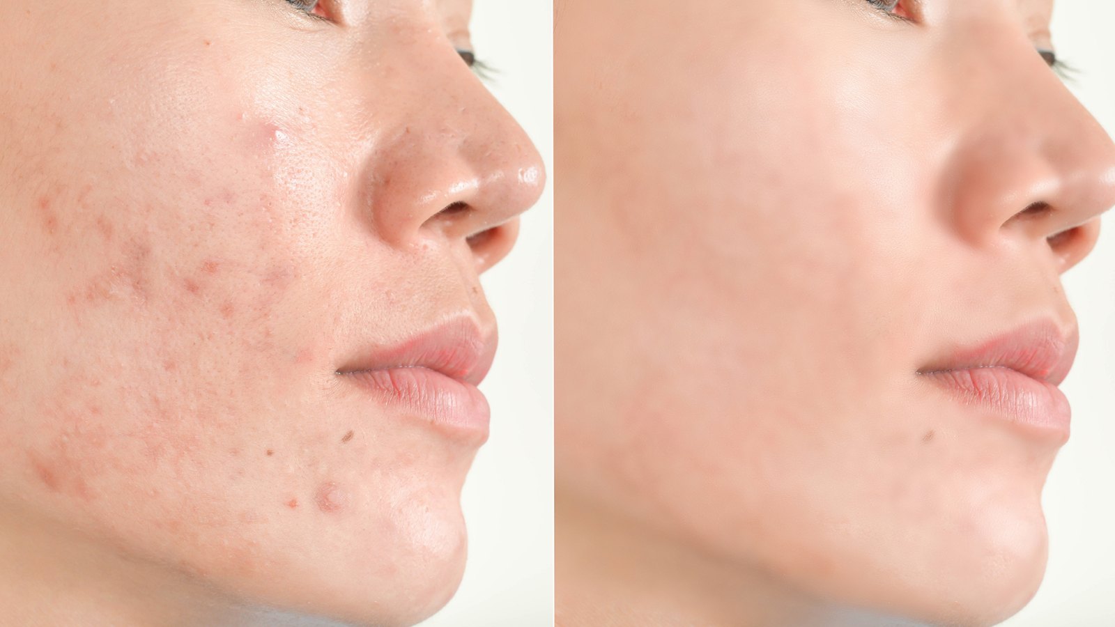 Acne scars and pores. Black spots, wrinkles and skin problems Facial Treatment Step
