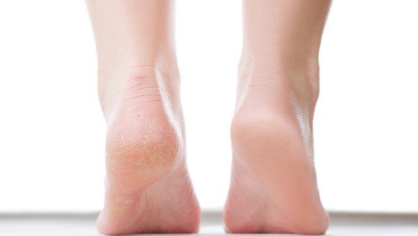 Before after feet care concept, female foot, chiropody isolated on white background, studio shot