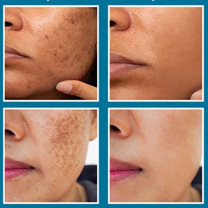 neutralyze-dark-spot-remover