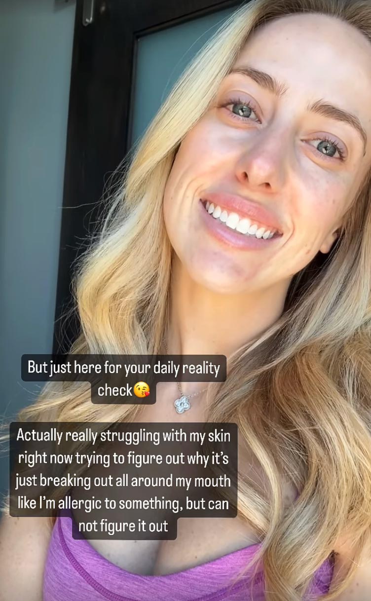Brittany Mahomes Admits She s Really Struggling With Acne Breakouts 495