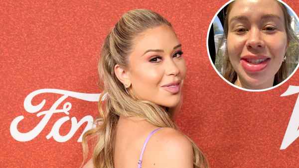 Gabby Windey Revealed Her Swollen Lips After Getting Filler Dissolved Help