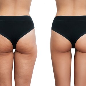 Young woman's thighs with cellulite before and after treatment isolated on white background.