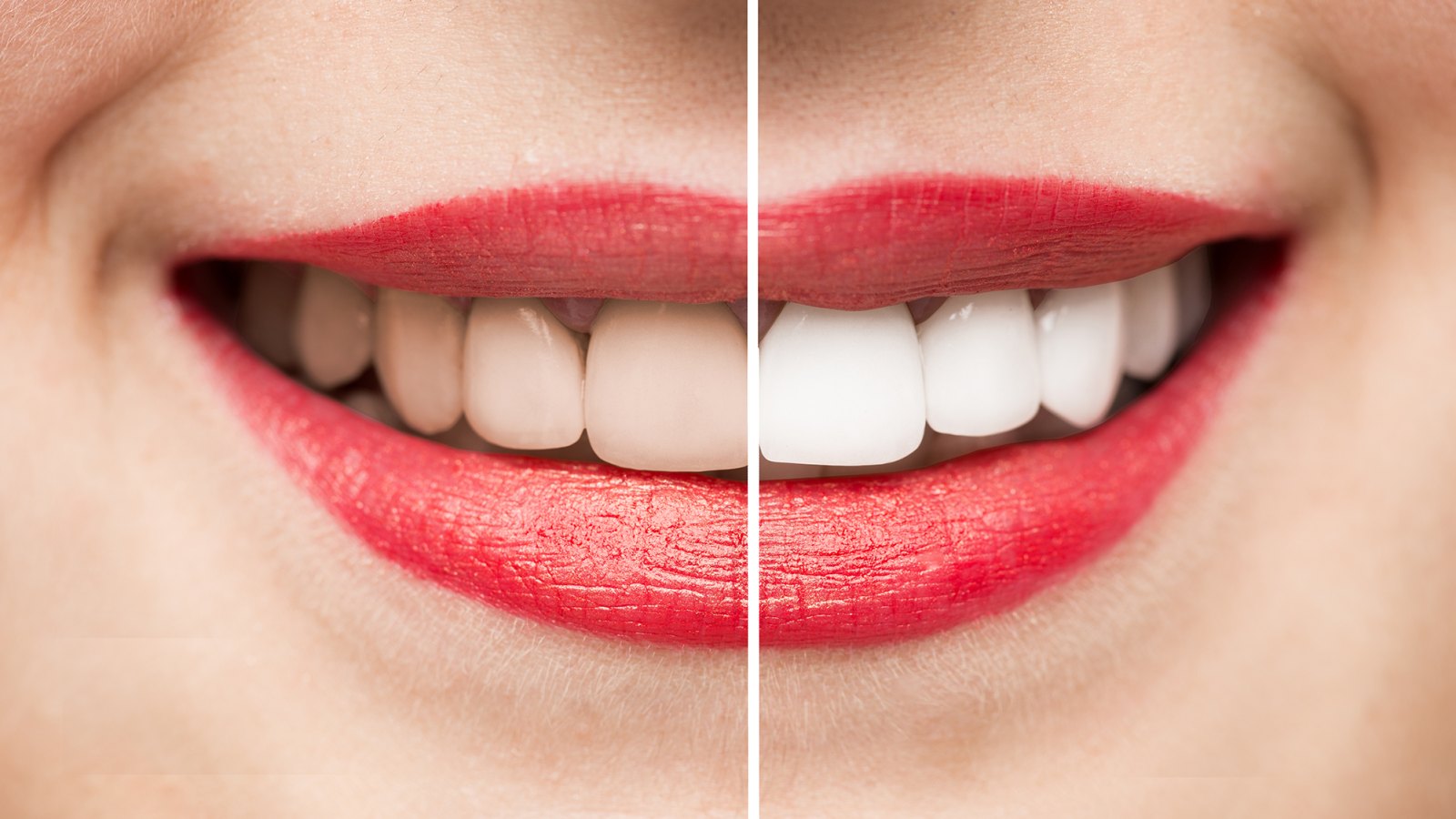 Teeth After and Before Whitening high quality studio shot