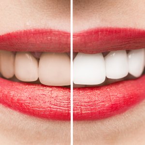 Teeth After and Before Whitening high quality studio shot