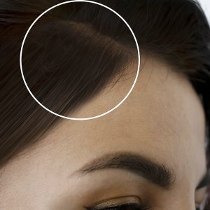 woman head baldness before and after treatment
