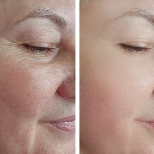 woman face wrinkles before and after treatment arrow