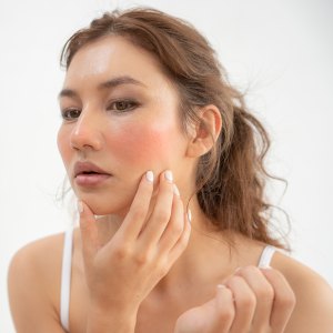 woman worried about face Dermatology and allergic to steroids in cosmetics. sensitive skin, red face from sunburn, acne, allergic to chemicals, rash on face. skin problems and beauty