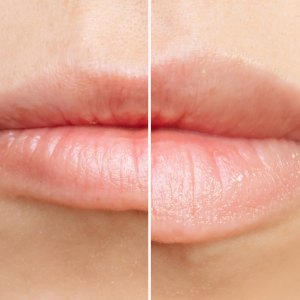 Result of lip augmentation. Cropped shot of young woman's lower part of face with lips before and after lip enhancement. Injection of filler in lips