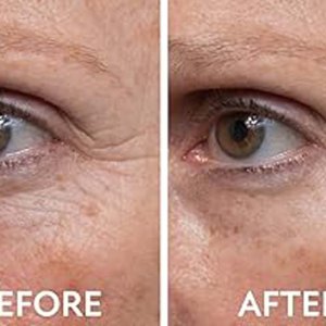 Eye Treatment