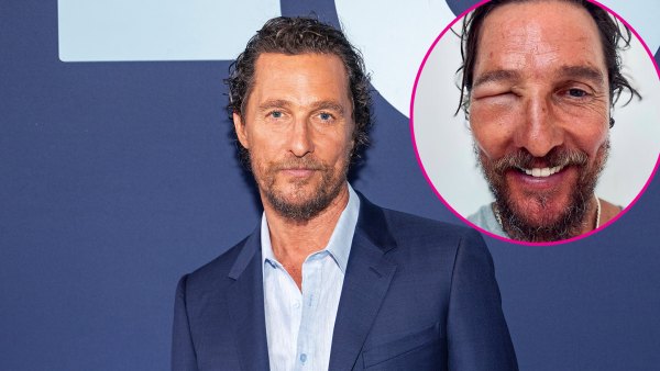 Matthew McConaughey Eye Swollen Shut by Bee