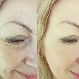 woman face wrinkles before and after treatment, collage