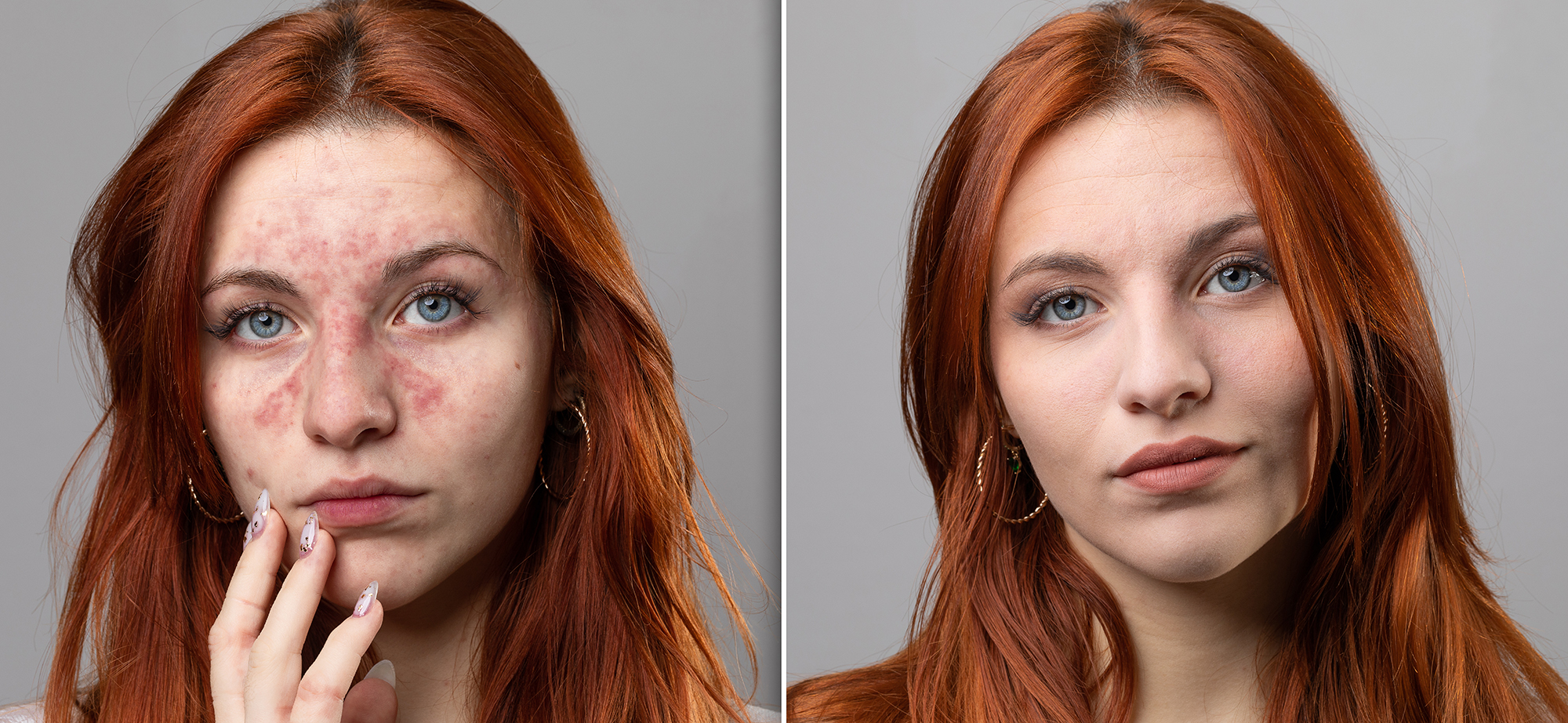 Before and after a rosacea laser treatment.