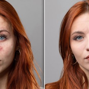 Before and after a rosacea laser treatment.