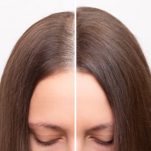 Before and after head shot of a young woman with a receding hairline on her forehead and parting. Baldness. Close-up, front view. Hair care and treatment concept. Hair loss, hair transplant, alopecia