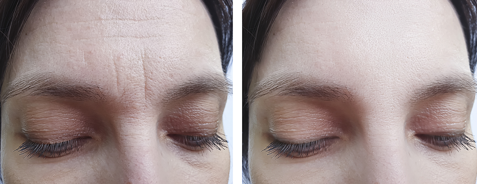 female forehead wrinkles before treatment