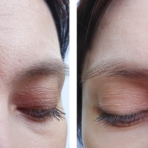 female forehead wrinkles before treatment