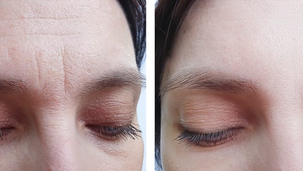 female forehead wrinkles before treatment