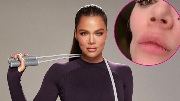 Khloe Kardashian Before andv After Facial Injections