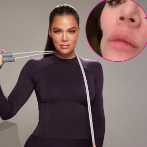 Khloe Kardashian Before andv After Facial Injections