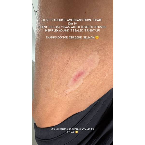 Danica Patrick habla tras la quemadura que tuvo por un café de ...