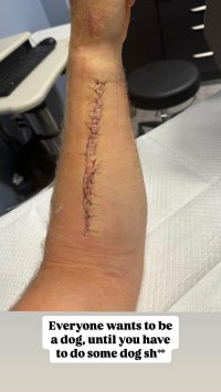 Detroit Lions LB Alex Anzalone Shares Gnarly Photo of Broken Forearm